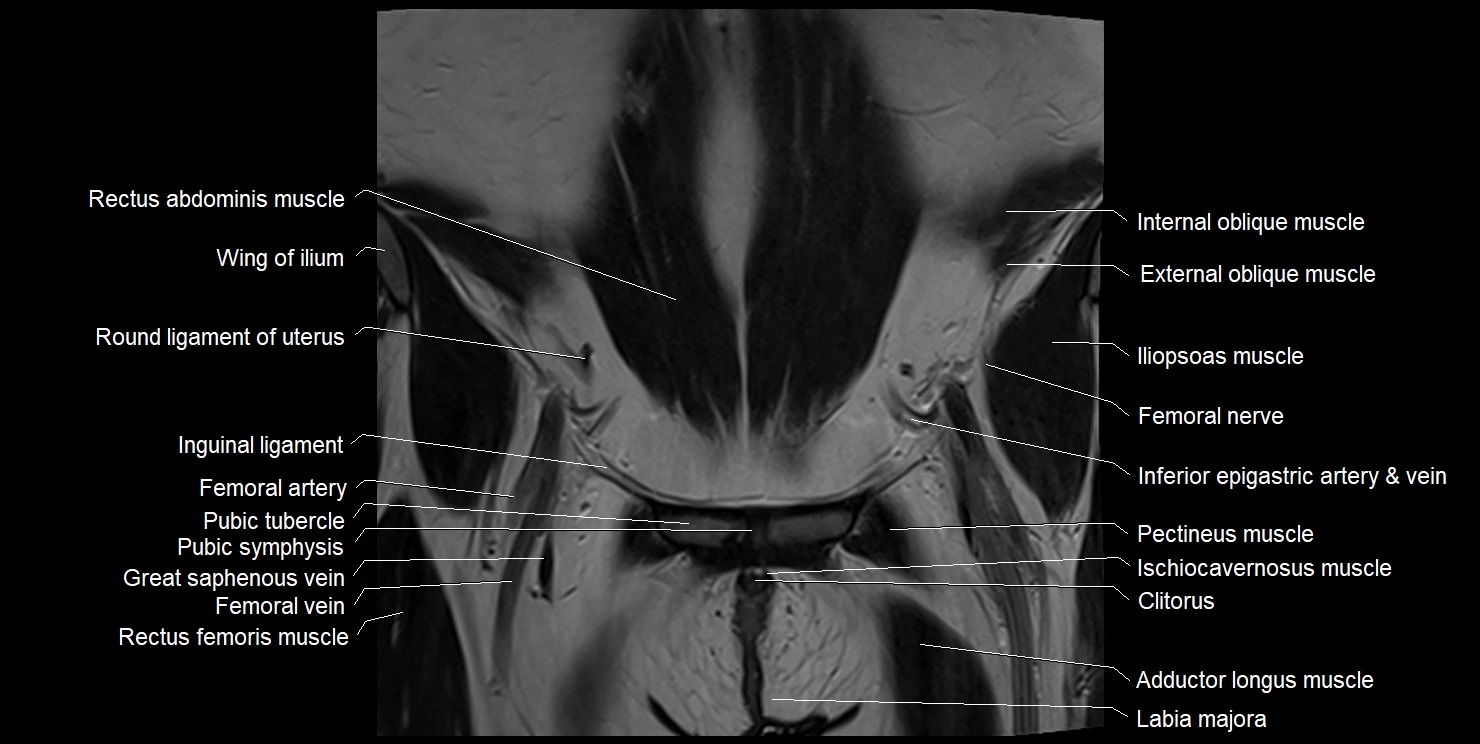 female pelvis coronal cross sectional anatomy image 6.webp